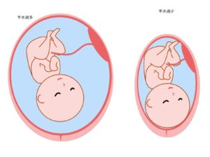 羊水過多・羊水過少を表したイラスト画像です。